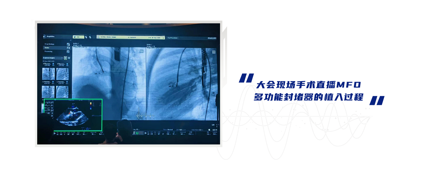 大会现场手术直播MFO多功能封堵器的植入过程.png